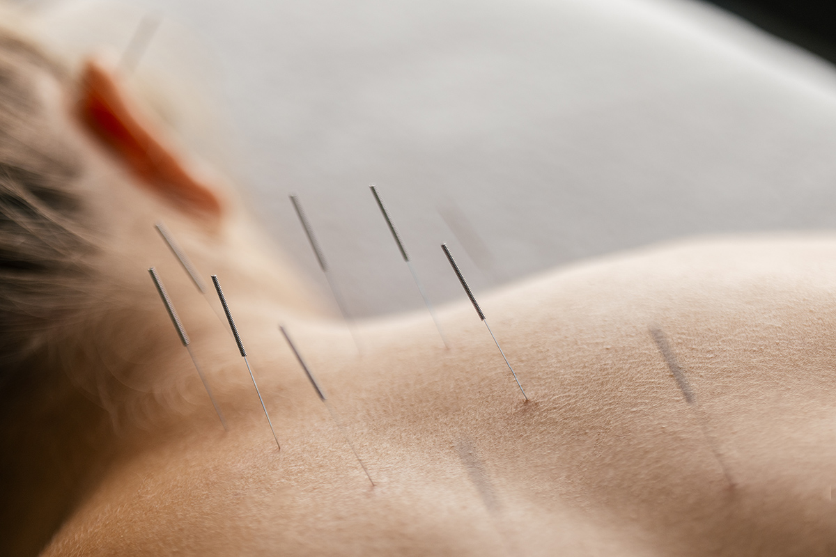 Acupuncture and Alternative Medicine in SUD Recovery